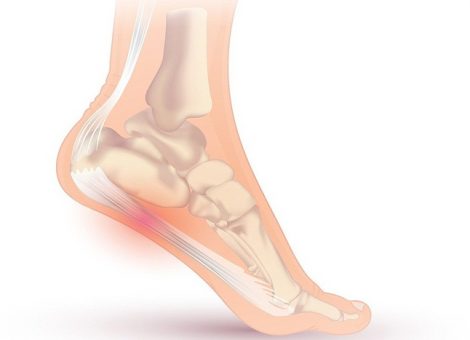 التهاب کف پا نشان چیست؟